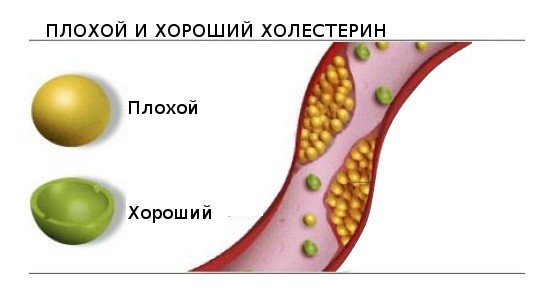 Холестерин хороший и плохой