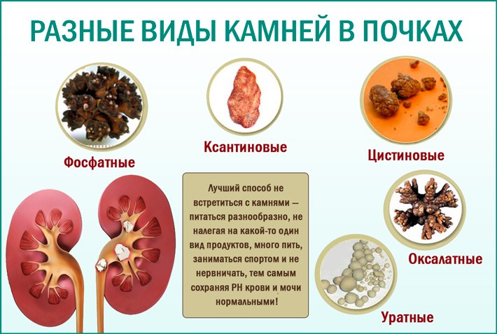 Мочекаменная болезнь картинки для презентации